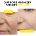 LANBENA Pore Solution Serum – Facial Serum for Pore Care, Hydration & Smooth-Looking Skin
